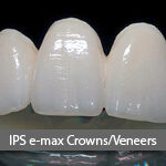 IPS-emax-crown