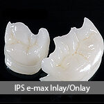 IPS-emax-inlay