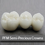 PFM-semi-precious