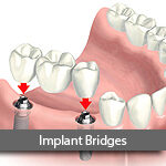 implant-bridge