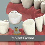implant-crown