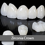 zirconia-crown